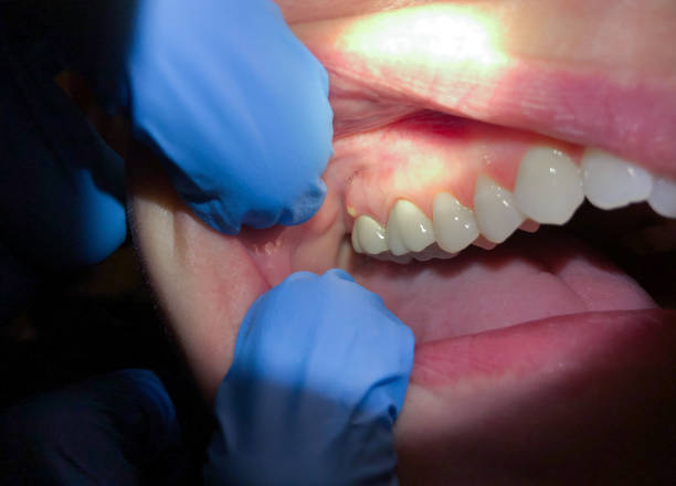 Best Broken or Chipped Tooth Repair in Matoaca, VA