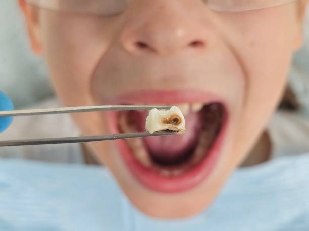 Best Knocked-Out Tooth (Avulsed Tooth) Treatment in Matoaca, VA